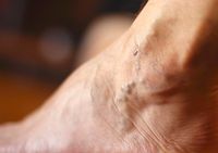 болки в краката - 72182 разновидности болки в краката - 44092 разновидности