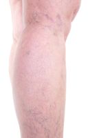 болки в краката - 15353 вида болки в краката - 32651 вида