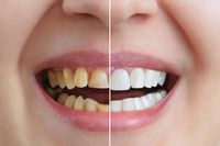 Invisalign - 34246 новини