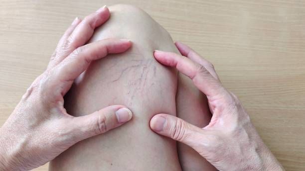 лечение на разширени вени - 13047 възможности