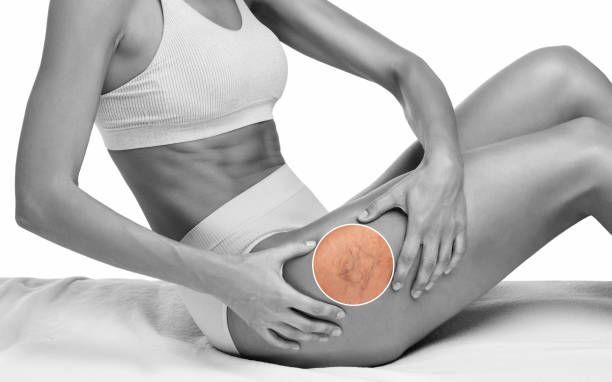 лечение на разширени вени - 25516 снимки